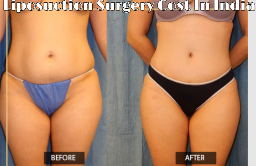 What is Liposuction Surgery Cost In India?