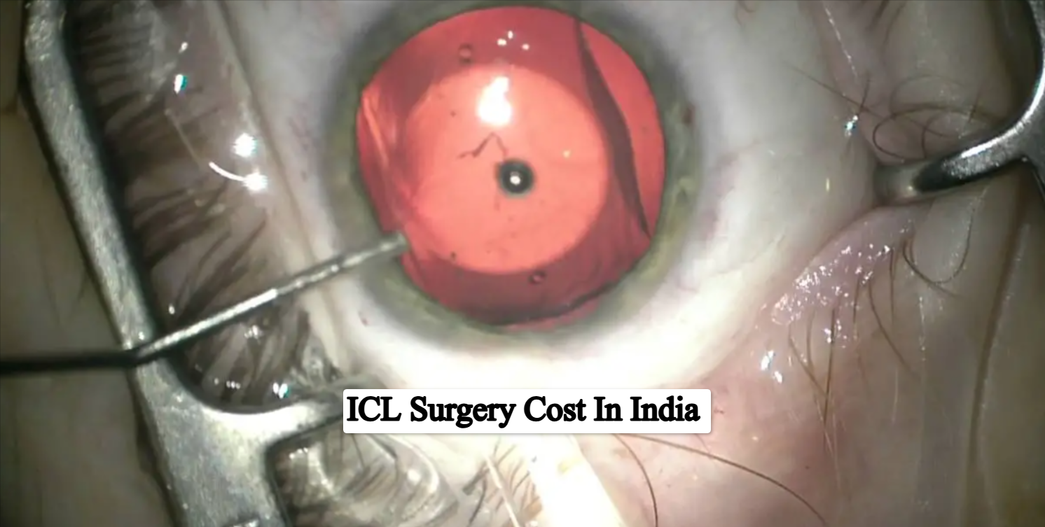What is ICL Surgery Cost In India?