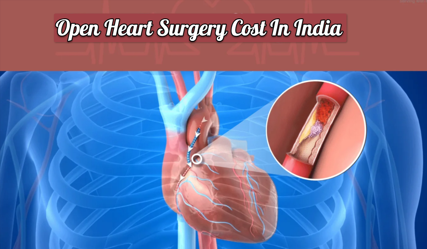 What is Open Heart Surgery Cost In India?
