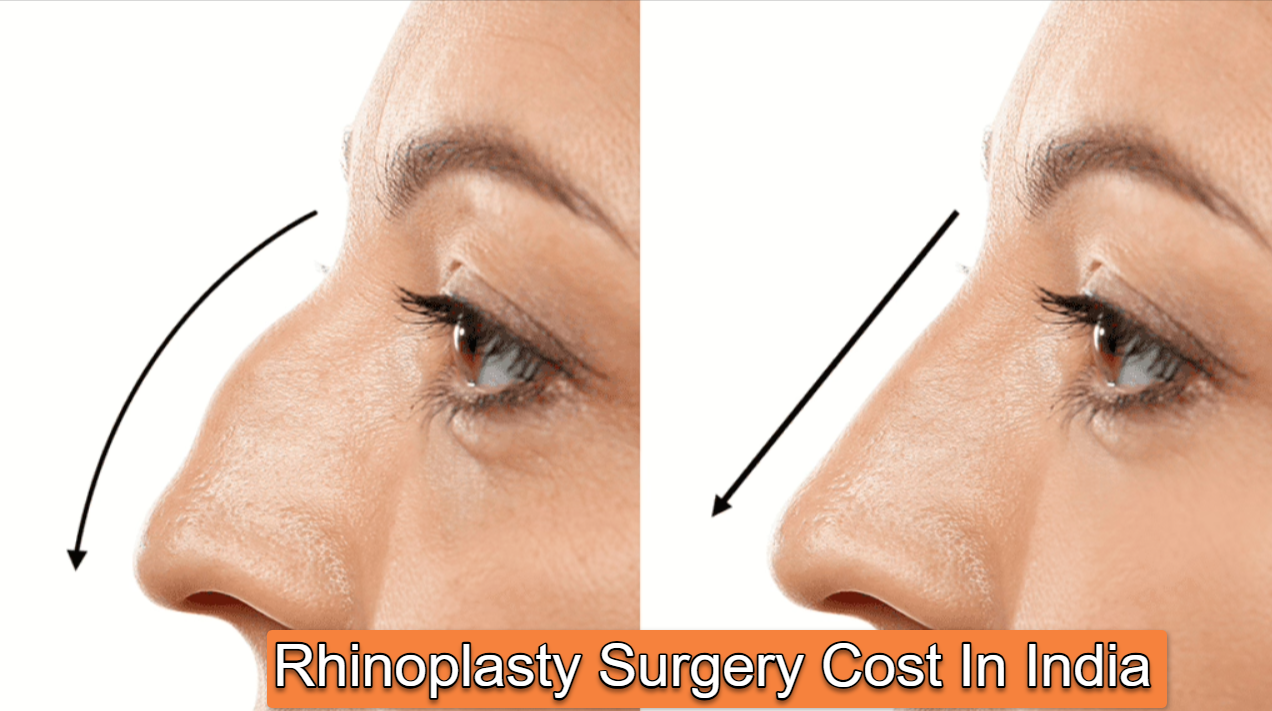 What is Rhinoplasty Surgery Cost In India?
