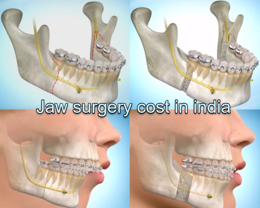 jaw surgery cost in india